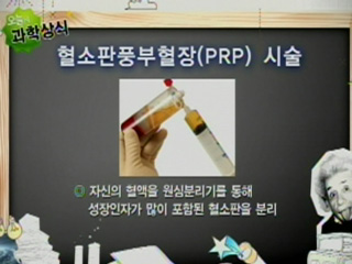 혈소판풍부혈장(PRP) 시술