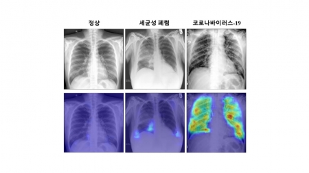 인공지능으로 코로나19 감염 진단기술 개발