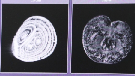 썩은 양파, MRI 영상으로 한눈에 골라낸다