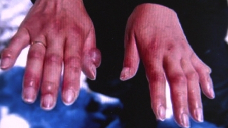 겨울 추위 시작..."저체온증·동상 등 한랭질환 주의"