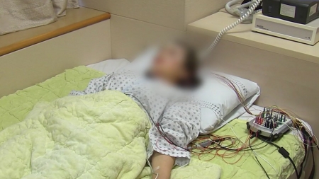 중등도 이상 수면무호흡증, 뇌 미세출혈 위험 2배↑