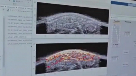 [사이다] ② 유방암 진단하는 광음향 스캐너? 