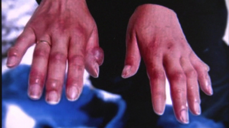 올겨울 3명 한랭질환으로 사망..."연말연시 술자리 주의"