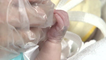 극소저체중아 뇌성마비 진단율 3.1%...8년 만에 반 감소