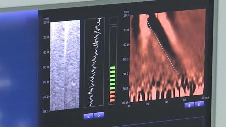 [사이다] ② 초음파로 간 속 '핏줄 지도' 그린다!