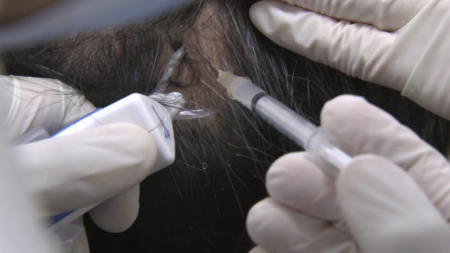 [사이다] ② 신규 펩타이드 개발로 안전한 탈모약 가능성 제시 