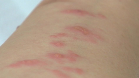 [사이다] ② 면역체계가 헤르페스 바이러스 감지하는 경료 규명