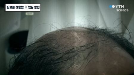 탈모를 예방할 수 있는 방법